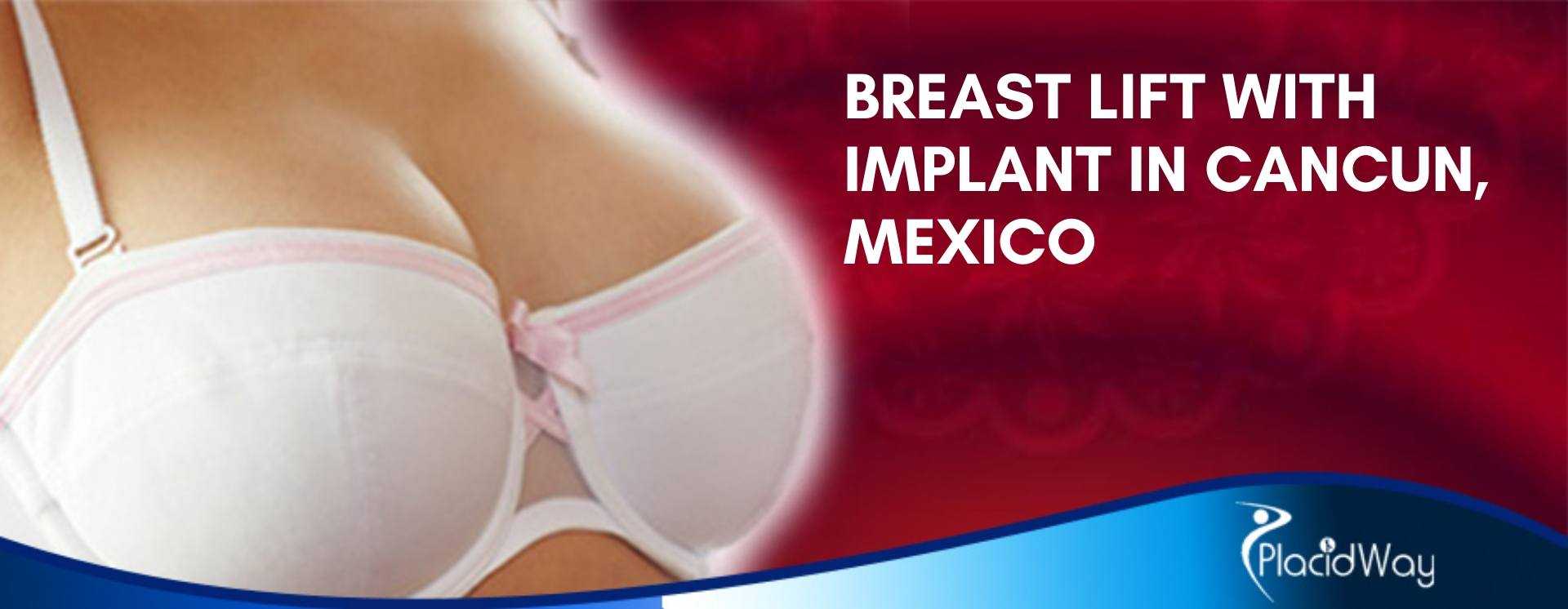 Breast Lift with Implant in Cancun, Mexico